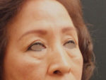 Eyelid Surgery