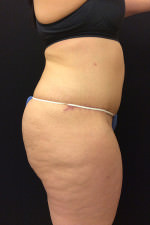 Liposuction