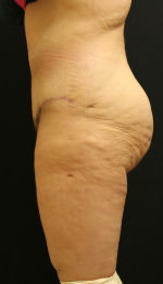 Liposuction