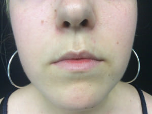 Lip Augmentation