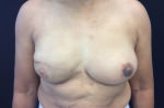 Breast Reconstruction