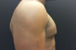 Gynecomastia