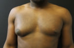 Gynecomastia