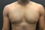Gynecomastia