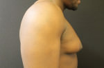 Gynecomastia