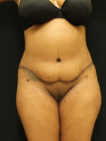 Liposuction