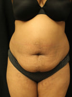 Liposuction