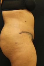 Liposuction