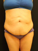 Liposuction