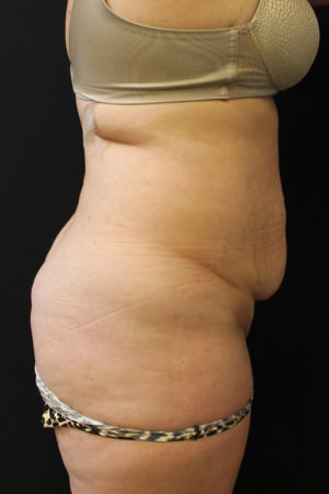 Liposuction
