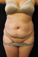 Liposuction