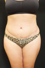 Liposuction