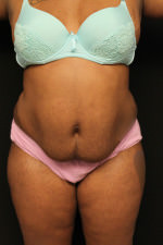 Liposuction
