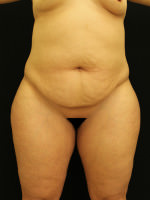Liposuction