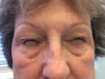 Eyelid Surgery