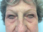 Eyelid Surgery