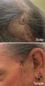 Basal Cell Carcinoma