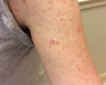 Basal Cell Carcinoma