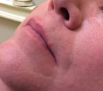 Basal Cell Carcinoma