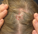 Basal Cell Carcinoma
