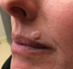 Basal Cell Carcinoma