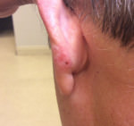 Basal Cell Carcinoma