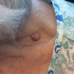 Basal Cell Carcinoma