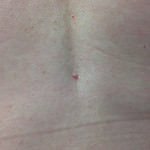 Basal Cell Carcinoma