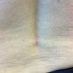 Basal Cell Carcinoma