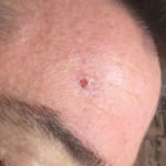 Basal Cell Carcinoma