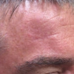 Basal Cell Carcinoma
