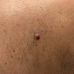 Basal Cell Carcinoma