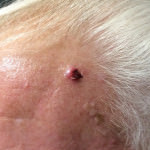 Basal Cell Carcinoma
