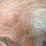 Basal Cell Carcinoma