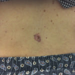 Basal Cell Carcinoma
