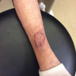 Basal Cell Carcinoma