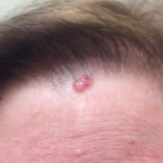 Basal Cell Carcinoma