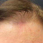Basal Cell Carcinoma
