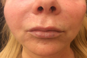Lip Augmentation