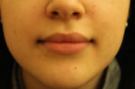 Lip Augmentation
