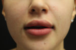 Lip Augmentation