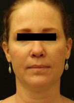 Restylane and Perlane