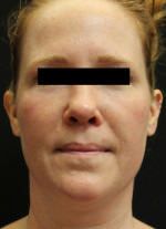 Restylane and Perlane