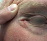 Basal Cell Carcinoma