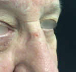 Basal Cell Carcinoma