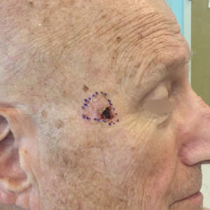Squamous Cell Carcinoma
