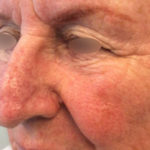Basal Cell Carcinoma