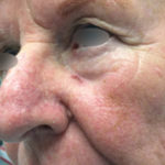 Basal Cell Carcinoma