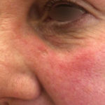 Basal Cell Carcinoma