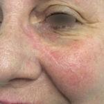 Basal Cell Carcinoma